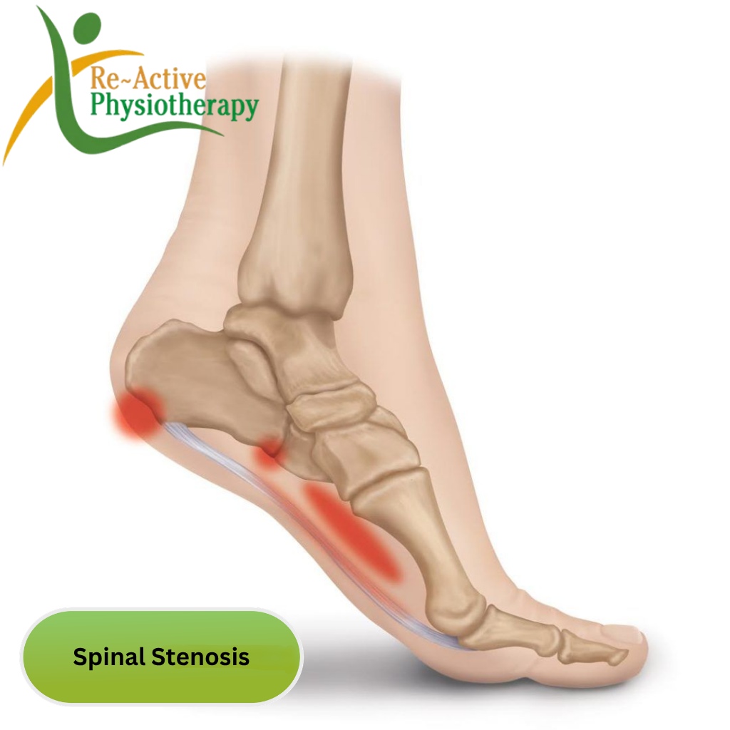 Plantar Fasciitis